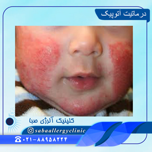 درماتیت-آتوپیک