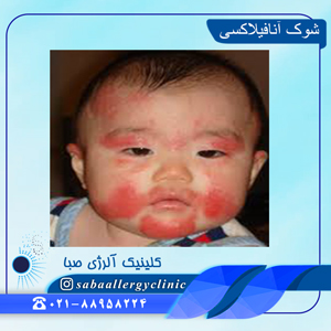 شوک-آنافیلاکسی